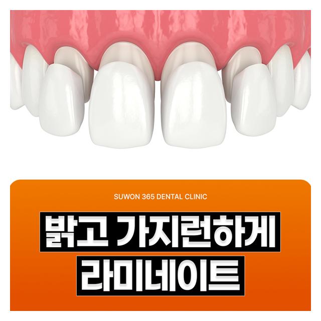 밝고 가지런한 치아 라미네이트 시술